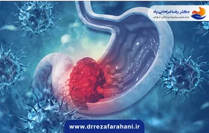 سرطان معده دکتر رضا فراهانی
