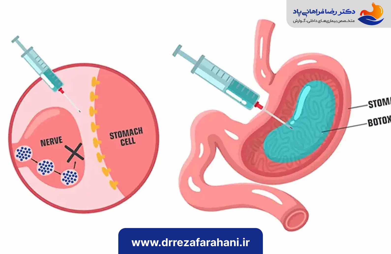 بهترین دکتر بوتاکس معده در تهران ، بوتاکس معده