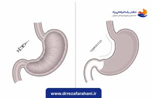 بوتاکس معده یا اسلیو معده