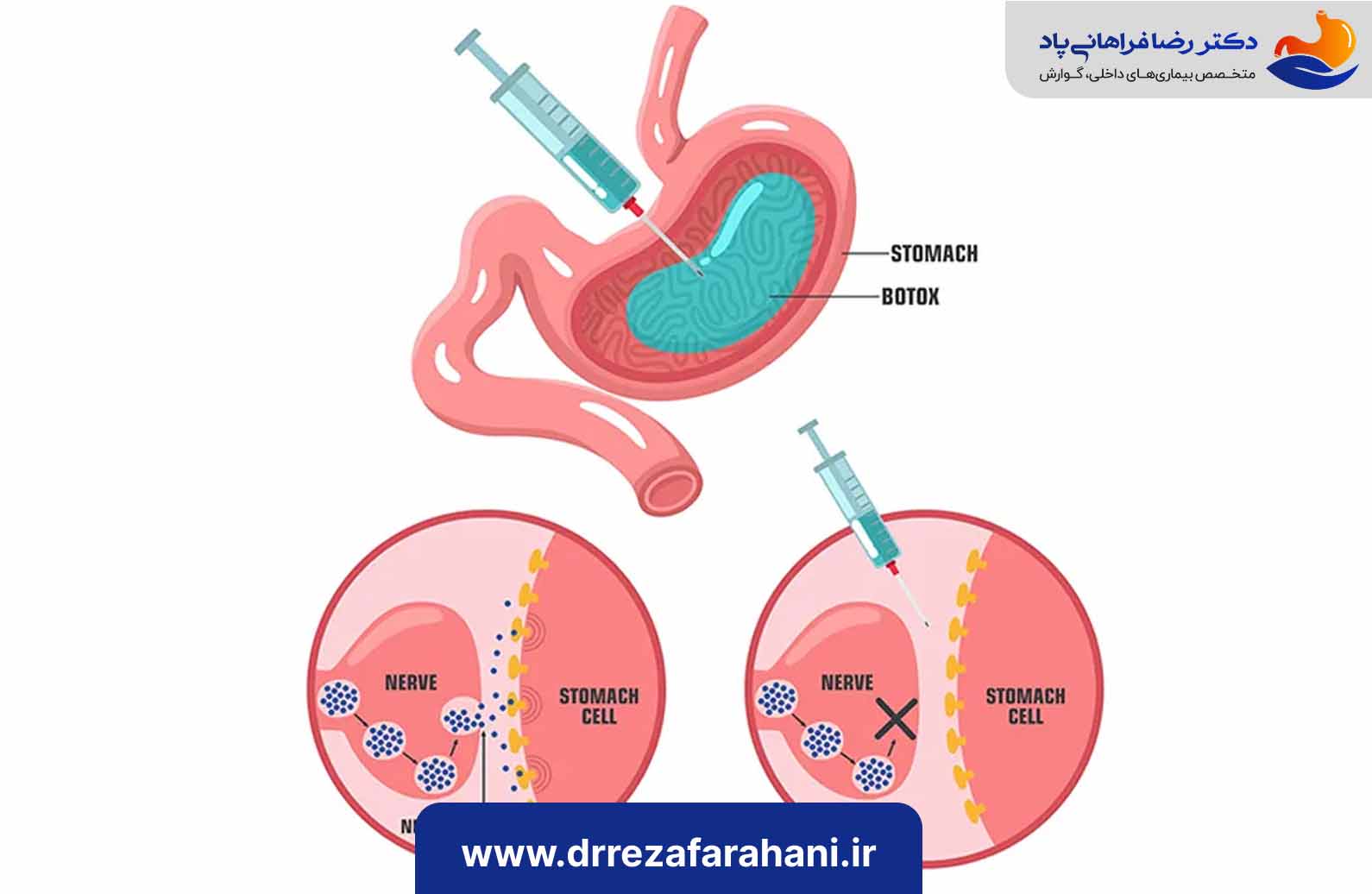 پوشش بیمه‌ای بوتاکس معده