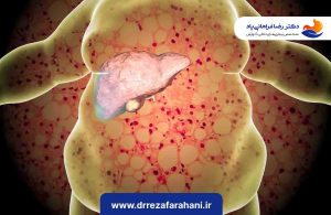 درمان کبد چرب با بوتاکس معده