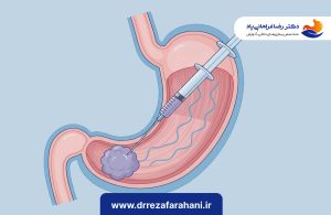 سرطان معده ، بوتاکس معده