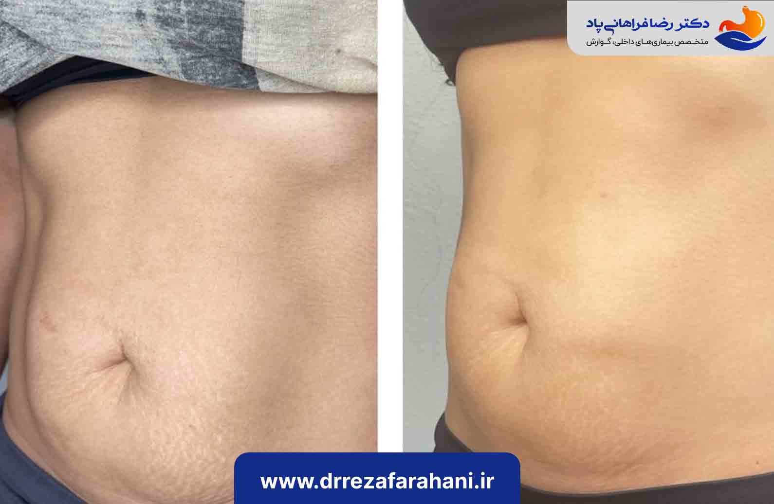 آیا بوتاکس معده دائمی است؟