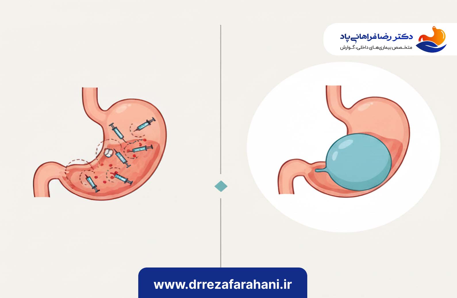 تفاوت بوتاکس معده و بالن معده