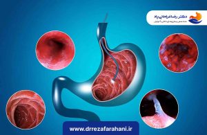 آیا بوتاکس معده دائمی است؟